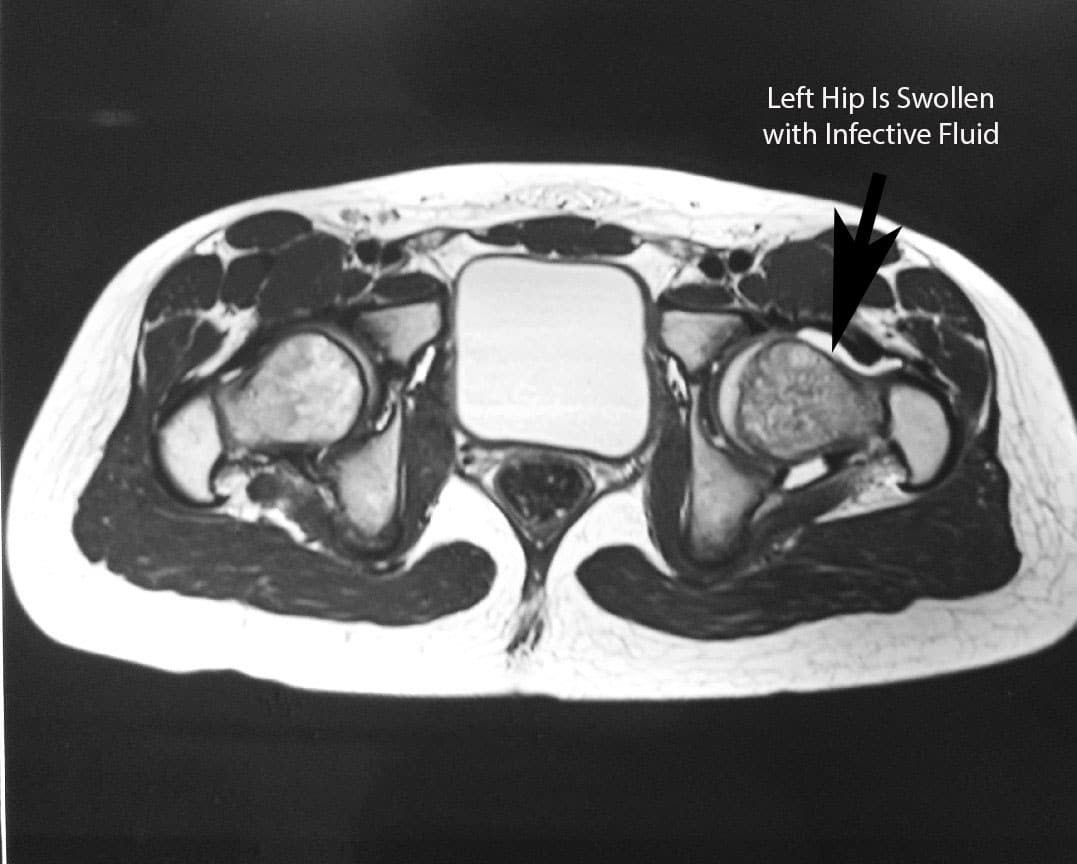 MRI showing fluid in the left hip joint causing a tense distension of that joint capsule