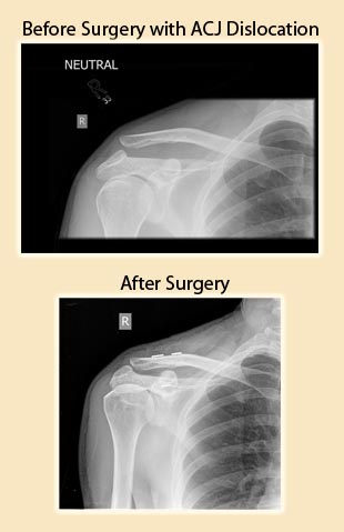 Before & After Surgery with ACJ Dislocation