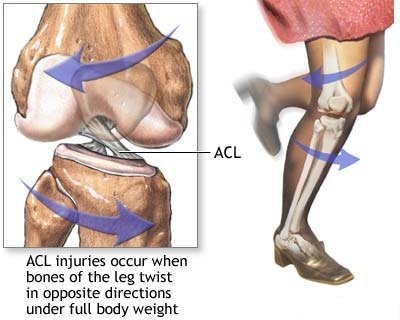ACL Mechanism of Injury