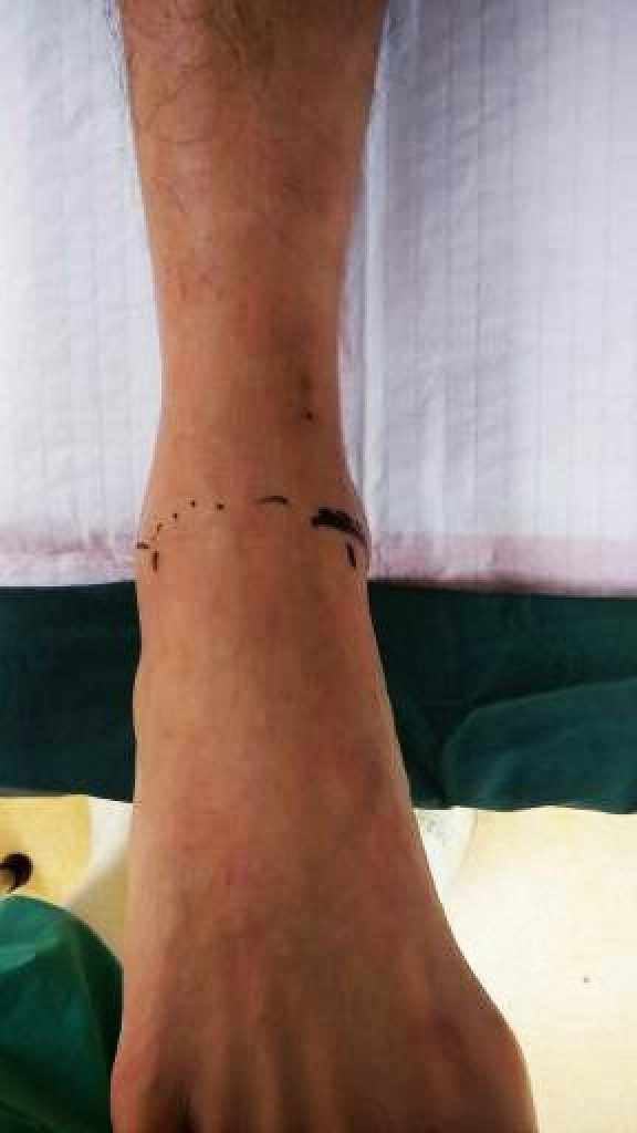 Pvns Rash Pigmented Villonodular Synovitis (PVNS) of the Ankle Treatment