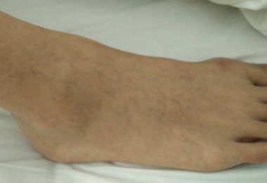 PVNS of the Ankle | Sudden Acute Ankle Pain