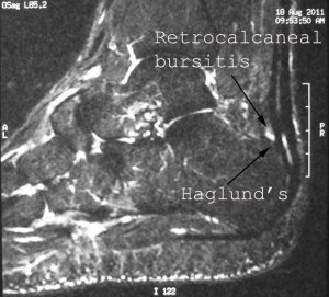 MRI of Haglund's with Retrocalcaneal Bursitis