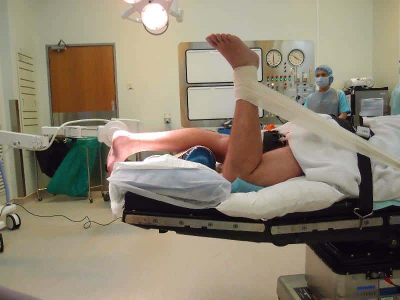 Endoscopic Calcaneoplasty Position