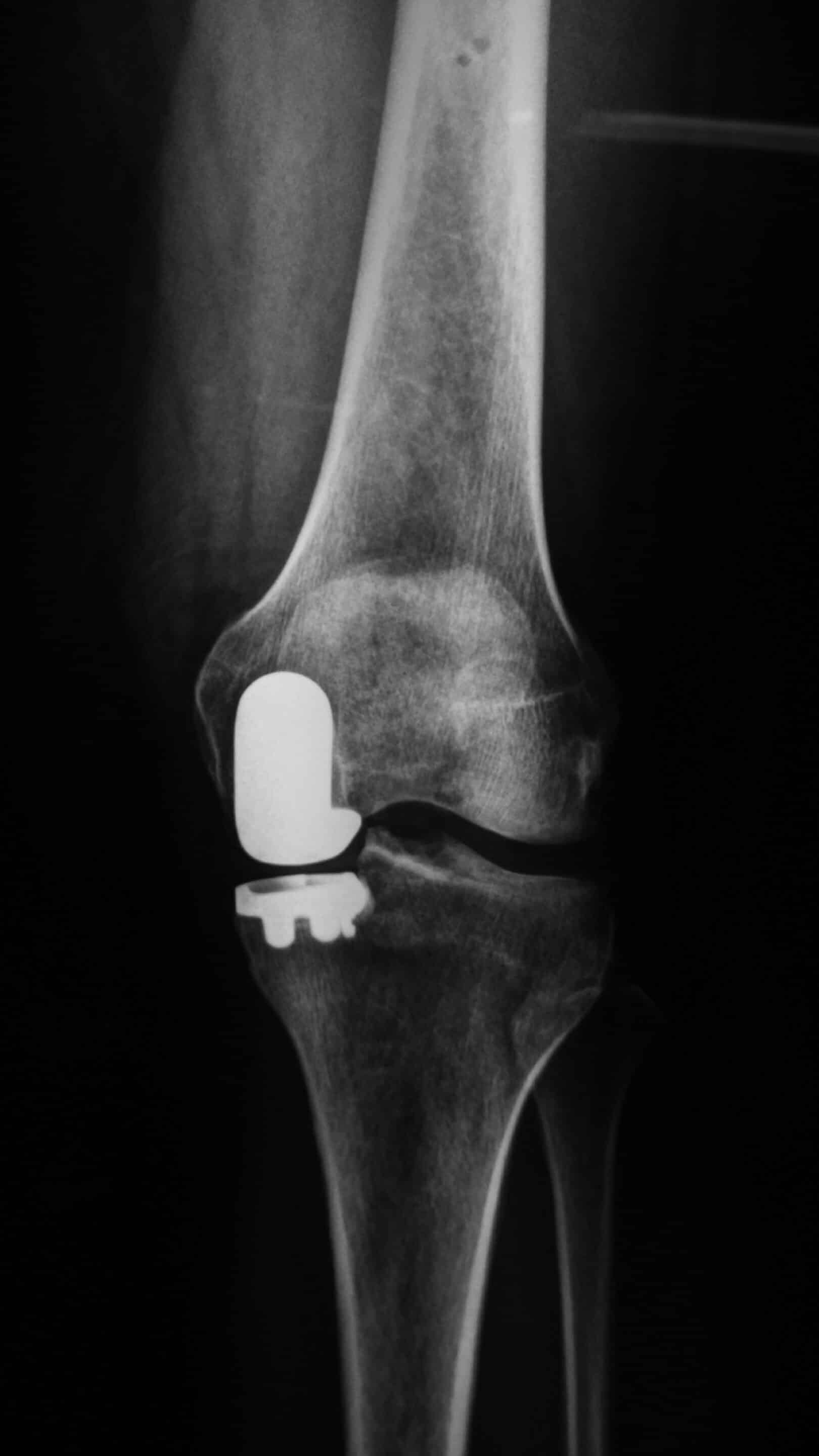 Failure of Uni-Compartmental Knee Replacements