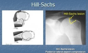 Hillsach’s lesion