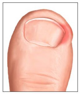 ingrown-toenail-pic