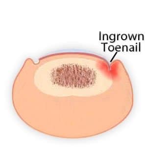 Ingrown Toenail