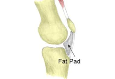Fat Pad Impingement Syndrome – A Cause Of Anterior Knee Pain