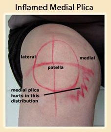 Inflamed Medial Plica 2
