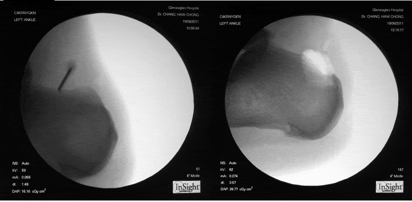 Pre and Post Endoscopic Calcaneoplasty