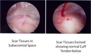 Scar Tissues in Subacromial Space