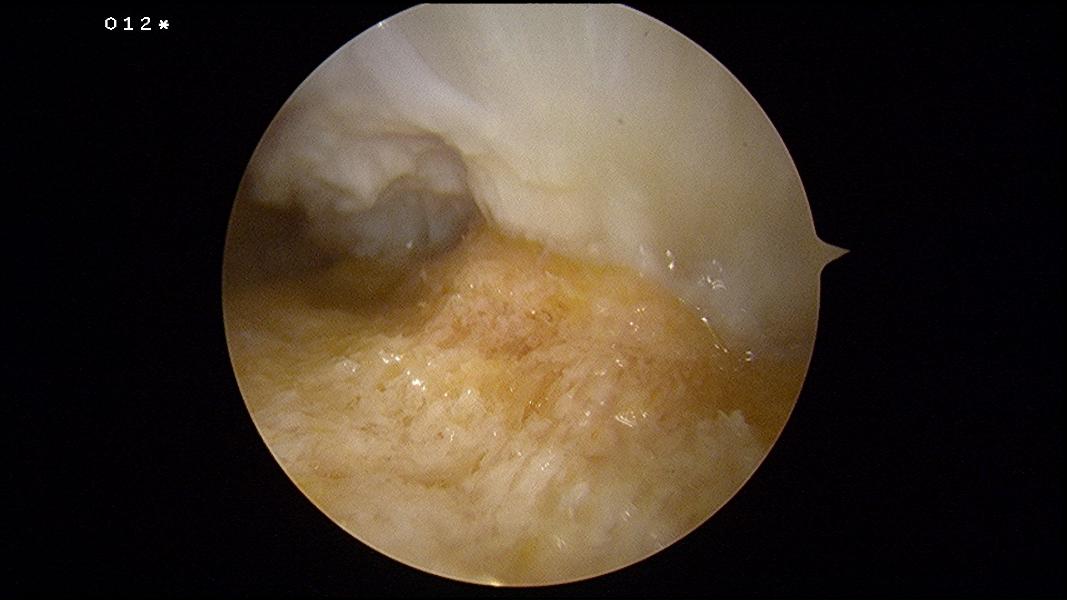 View from lateral portal showing the Achilles tendon insertion
