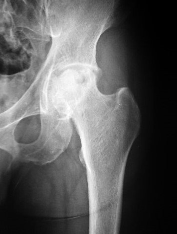 Avascular Necrosis of the Hip Joint