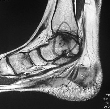 Persistent Pain After Ankle Sprain – Think of Talus OCL