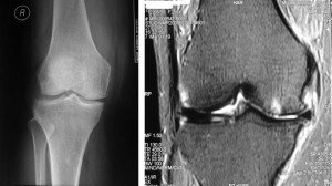 Medial Compartment Osteoarthritis Knee