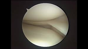 Right Knee Medial Menisco-Capsular Separation