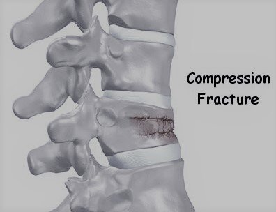 Percutaneous Vertebroplasty for Osteoporotic Compression Fractures of the Spine