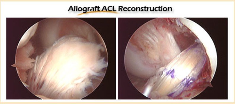 ACL Tears – How To Diagnose Them?