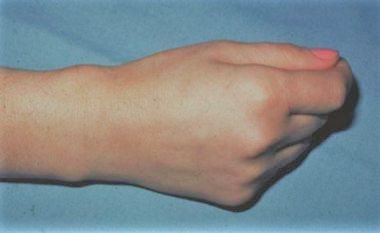 De Quervain’s Tenosynovitis – A Cause of Wrist Pain