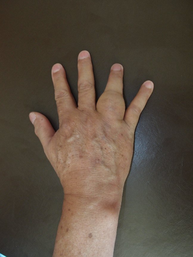 An Enlarging Lump in the Finger | Tumour of the Finger | Giant Cell Tumour of The Phalanx
