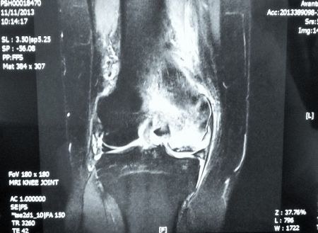 Avascular Necrosis of the Knee Joint | Role of a Partial Knee Replacement