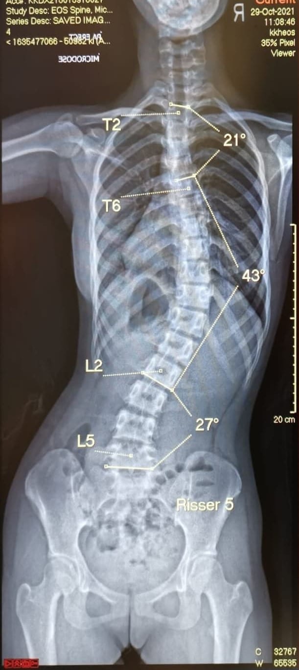 Curved Spine – Scoliosis – What You May Want to Know