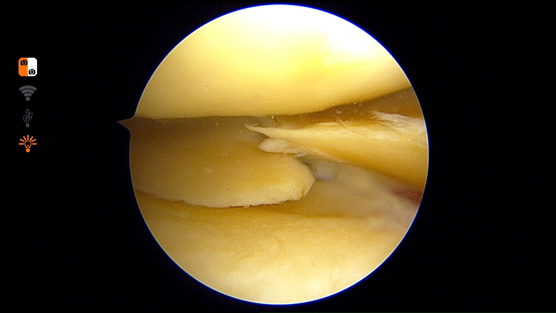 Repair of a Radial Tear of the Medial Meniscus
