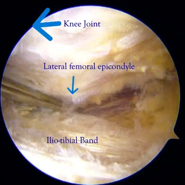The Procedure: Why Arthroscopic?